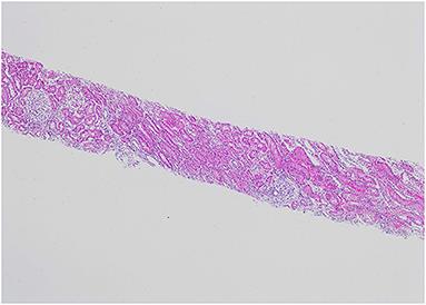 Case Report: A Rare Presentation of NSAID-Induced Secondary Membranous Nephropathy in a Pediatric Patient